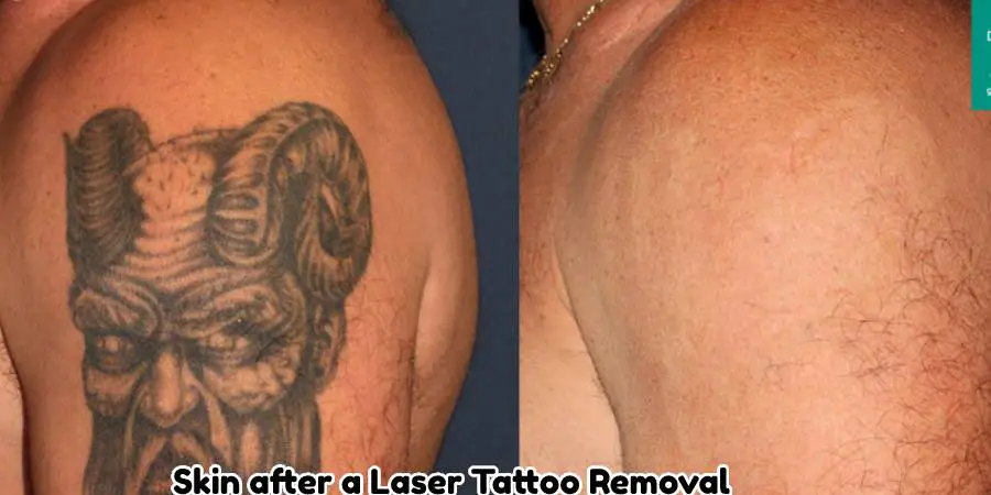Skin after a Laser Tattoo Removal